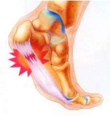 heel pain